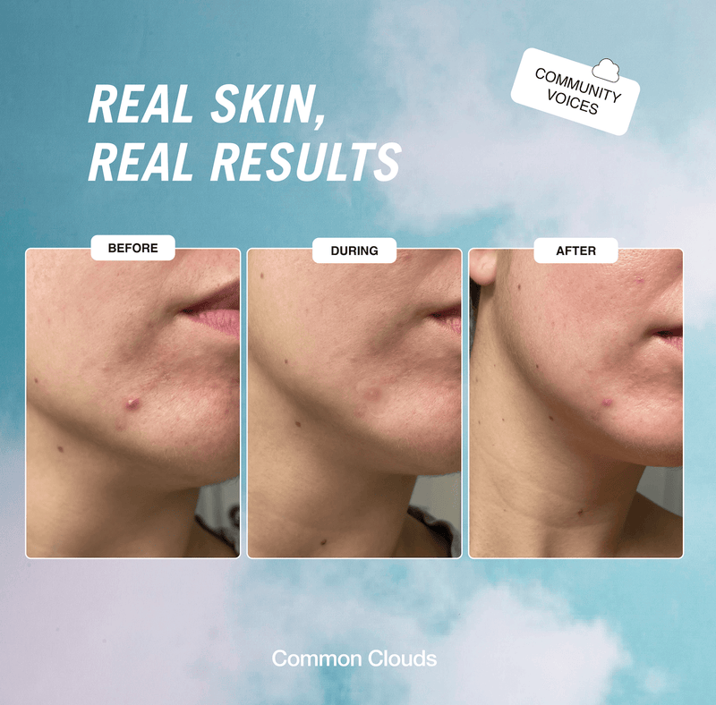 Cloud Patch pimple patch awarded "Best spot treatment"!
