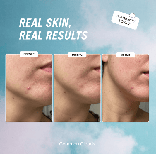 Cloud Patch pimple patch awarded "Best spot treatment"!