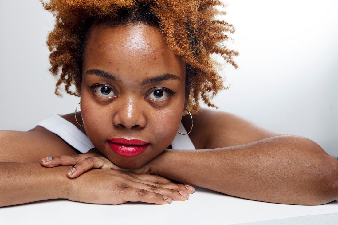 Acne in melanin-rich skin