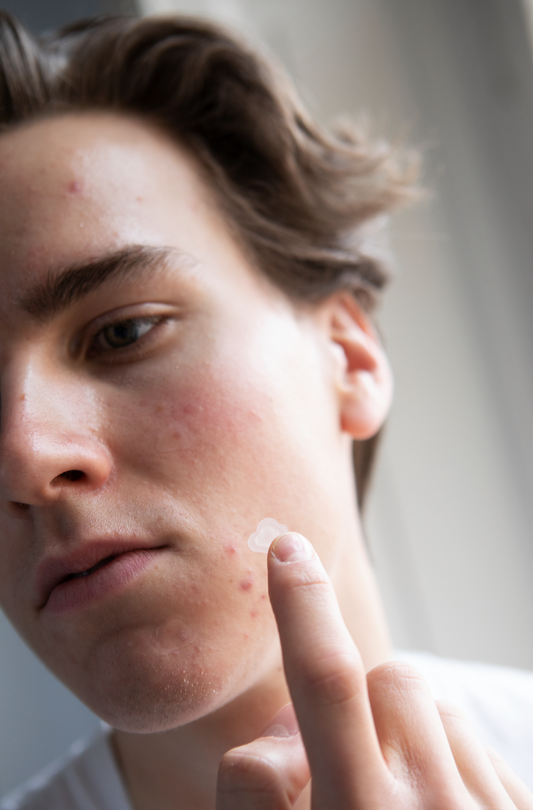 Boy using Common Clouds cloud-shaped pimple patch Cloud Patch on acne.