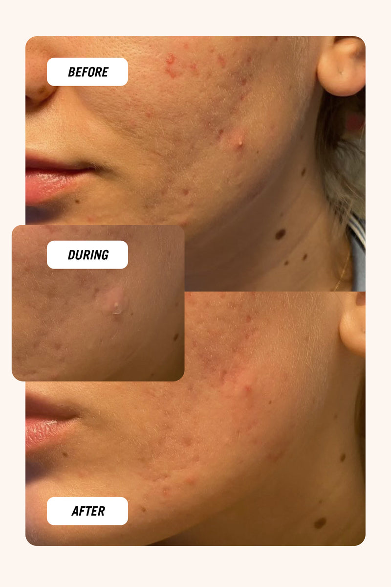 How to get rid of a pimple overnight