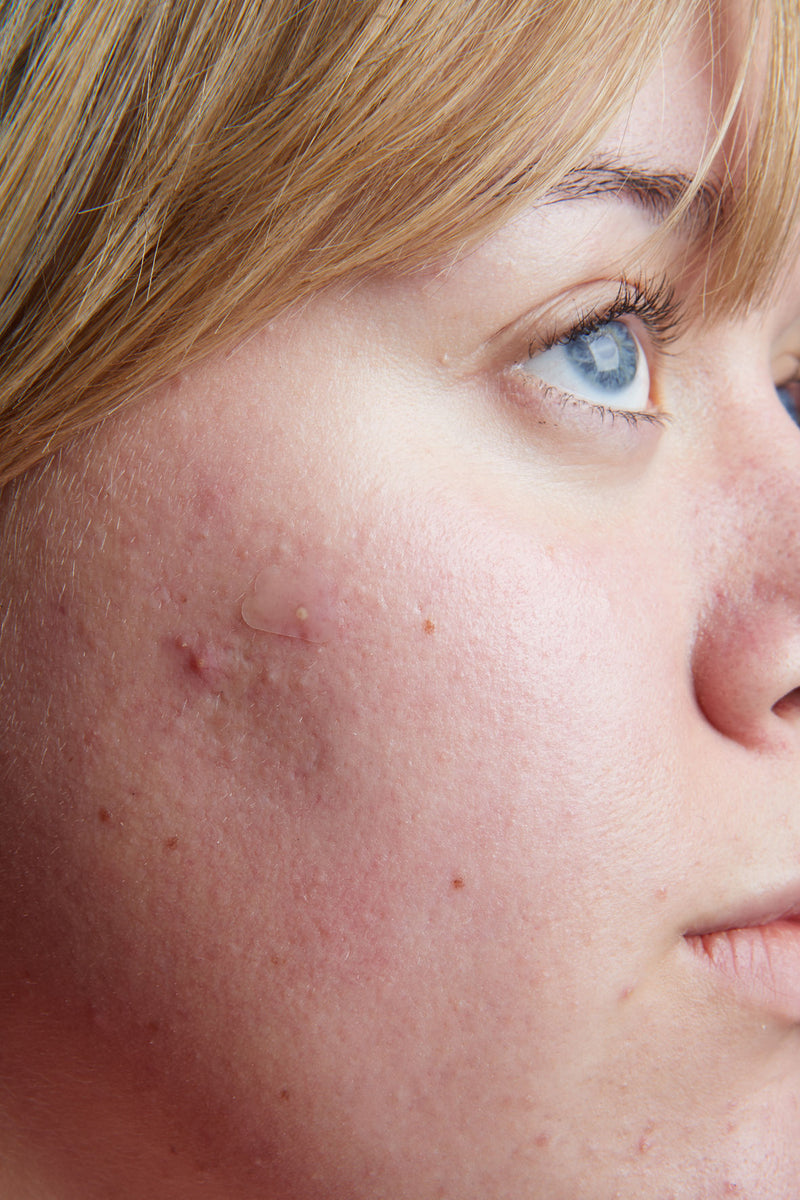 girl putting on a pimple patch finnplåster akneplåster