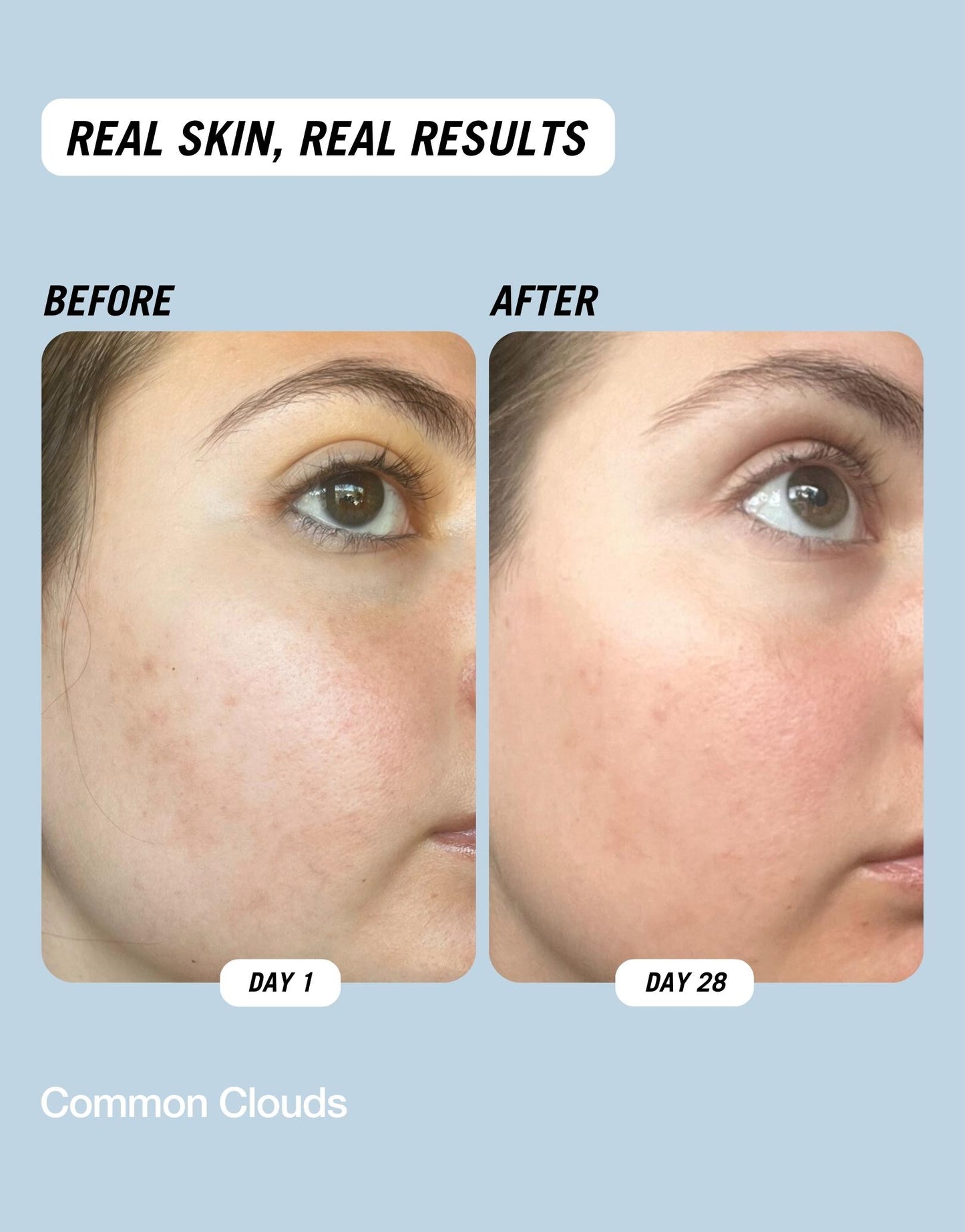Befor and after images showing the results after using Common Clouds Cloud Water BHA toner.