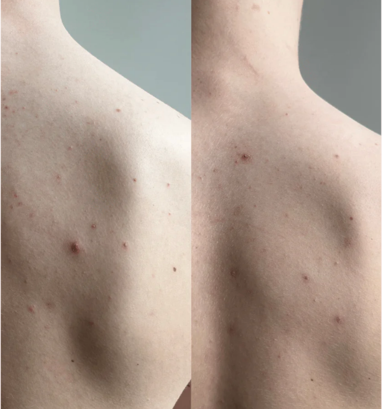 Before and after. Two images showing a back with pimples.