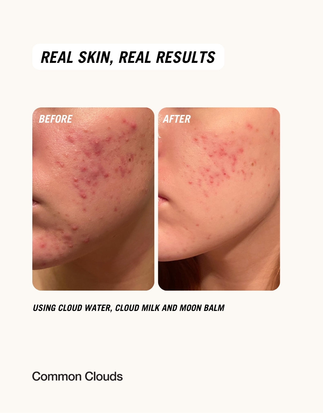 Before and after pictures showing the results after using Common Clouds Post blemish heroes.