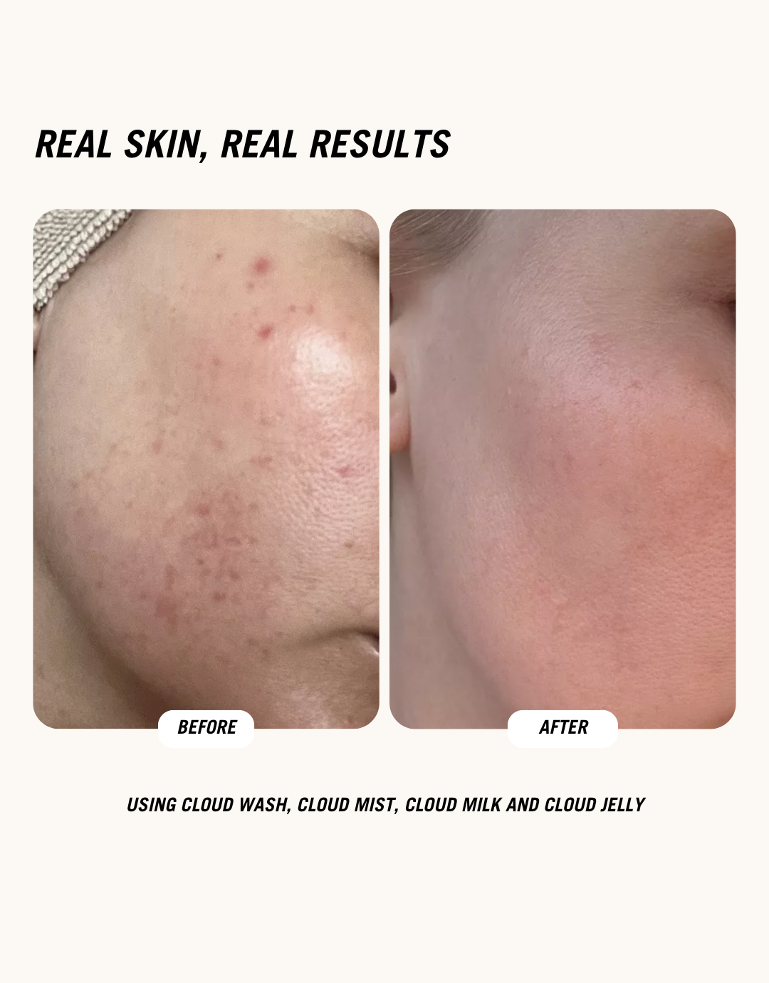 Acne and redness visibly reduced in before-and-after photo after using Cloud Wash, Cloud Mist, Cloud Milk, and Cloud Jelly skincare products for clear, smooth skin.
