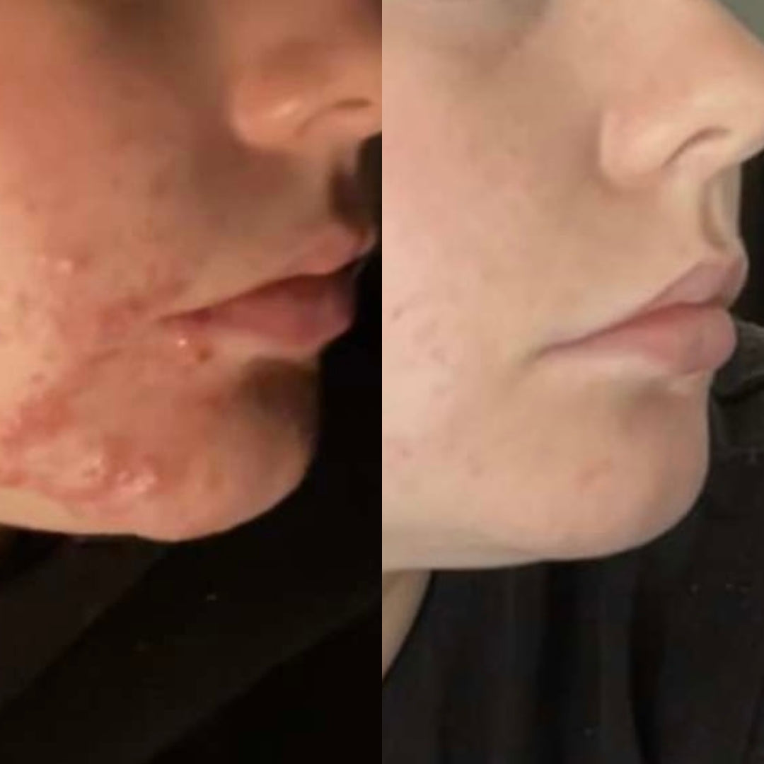 Before and after. Girl in profile showing her skin.