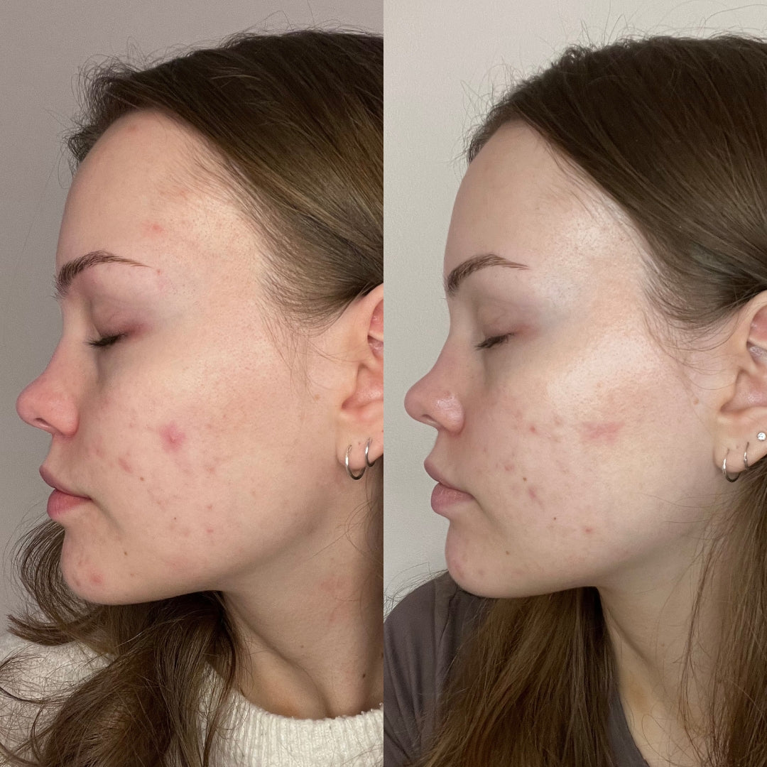 Before and after. Girl in profile showing her skin.