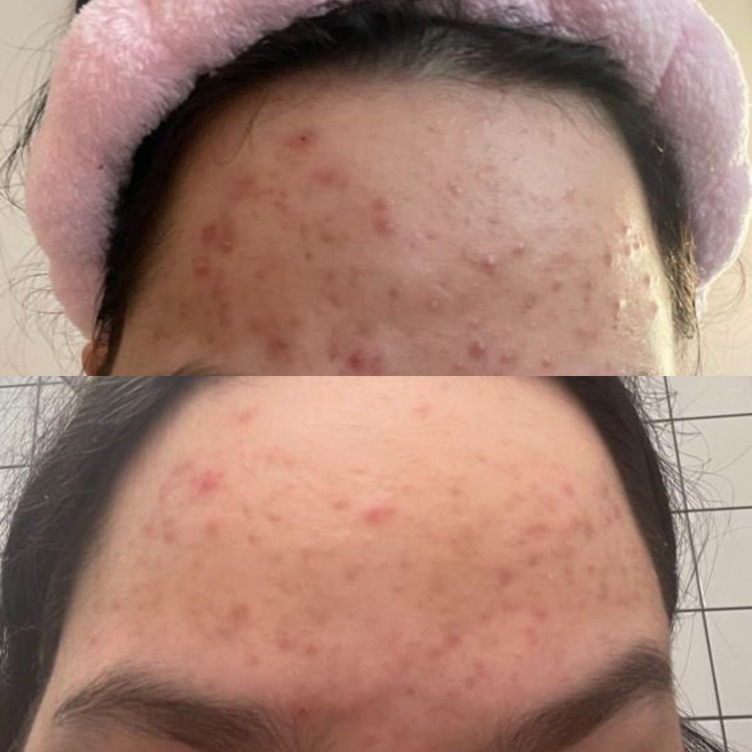 Before and after image of a girl showing her forehead after having used Common Clouds skincare products.