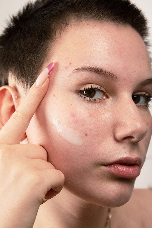 Girl showing acne breakouts on her chin in an article about skin purging and more breakouts after using BHA