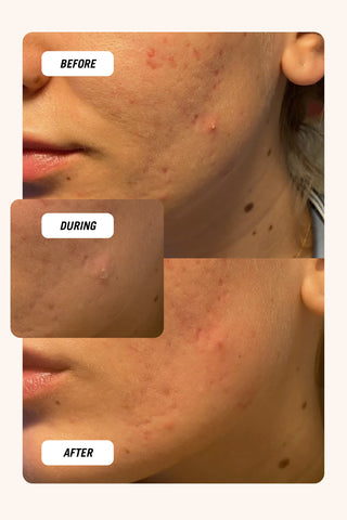 How to get rid of a pimple overnight