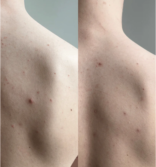 How to prevent and get rid of back acne and breakouts on the back – guide from Common Clouds. Guide till hur du blir av med finnar på ryggen.