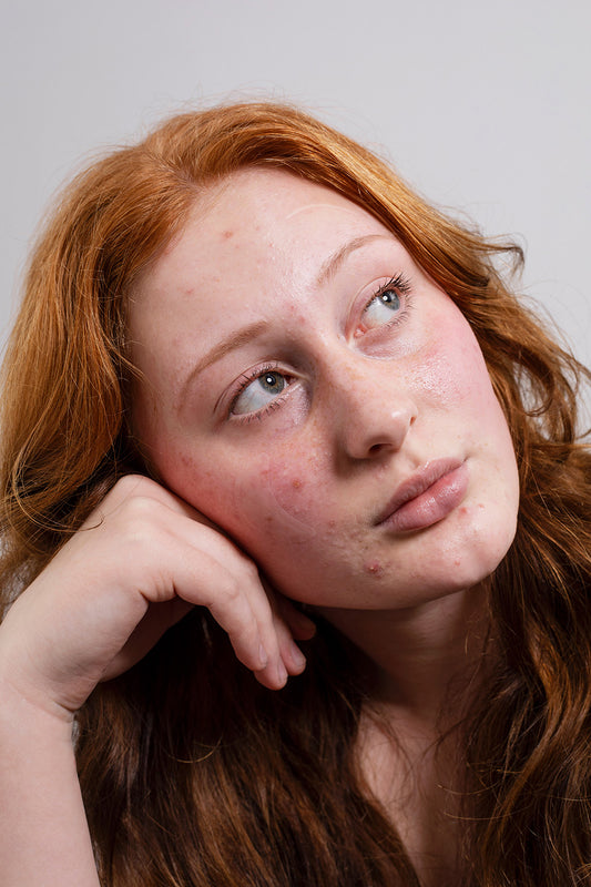 Why do I get acne? Causes and types of acne – according to a Dermatologist