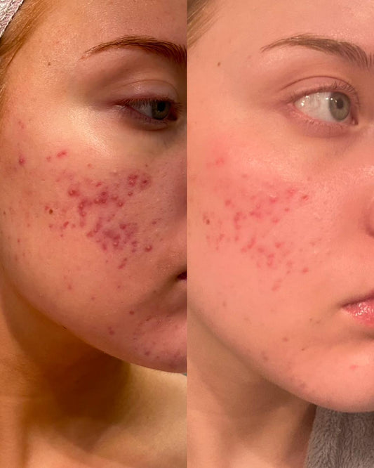 How to minimise post-acne scars