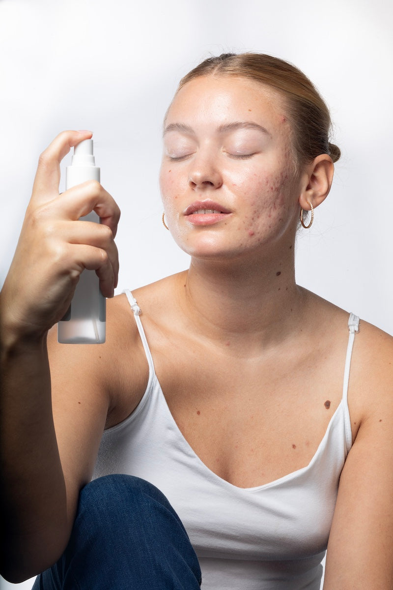 How to get rid of summer breakouts