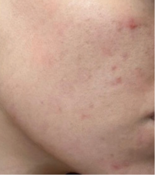Close-up of cheek and jawline with redness, blemishes, and some dark spots.