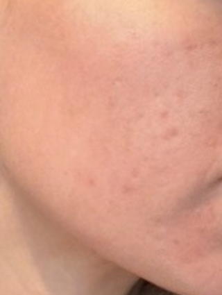 Close-up of cheek and jawline with less redness and fewer visible blemishes.