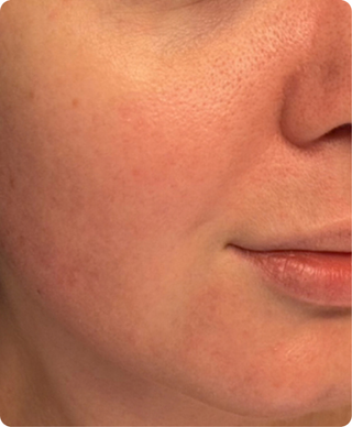 Close-up of cheek and lower face showing visible redness and uneven skin tone.
