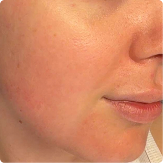 Close-up of cheek and lower face showing reduced redness and a more even-looking skin tone.