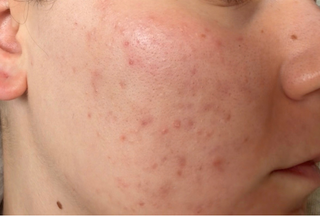 Close-up of cheek showing redness and blemishes.