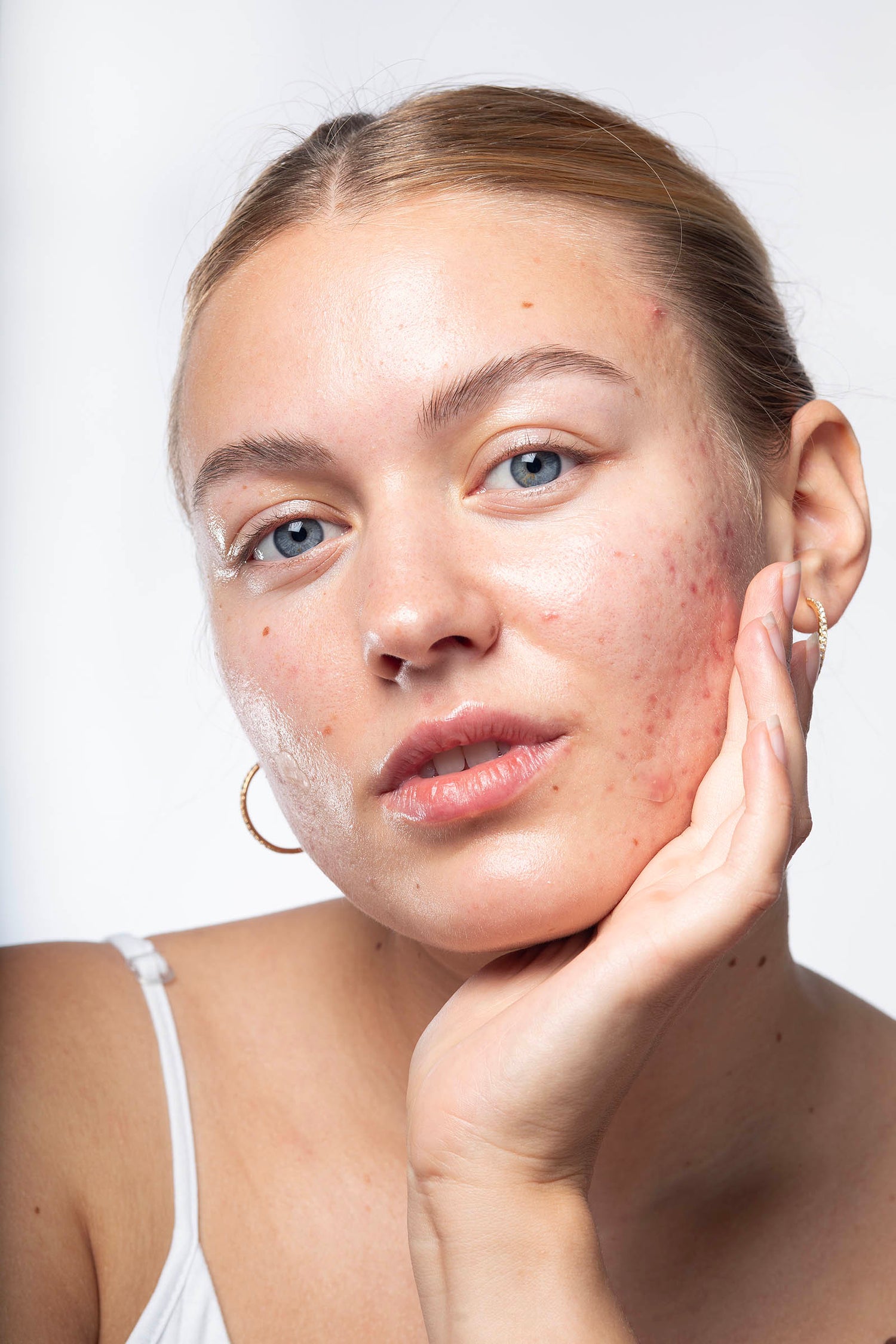 Woman with acne on her face against a white background