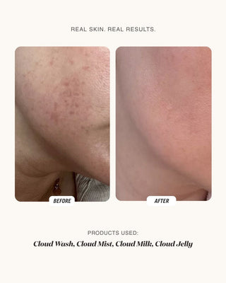 Before and after comparison of skin texture on a cheek, showing red blemishes and texture on the left labeled BEFORE, and clearer smoother skin on the right labeled AFTER. 