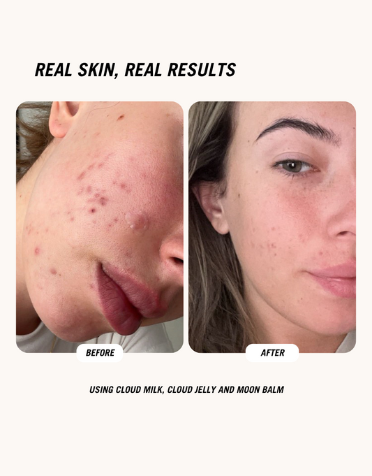 Acne and redness visibly reduced in before-and-after photo after using Cloud Milk, Cloud Jelly and Moon Balm skincare products from Common Clouds.