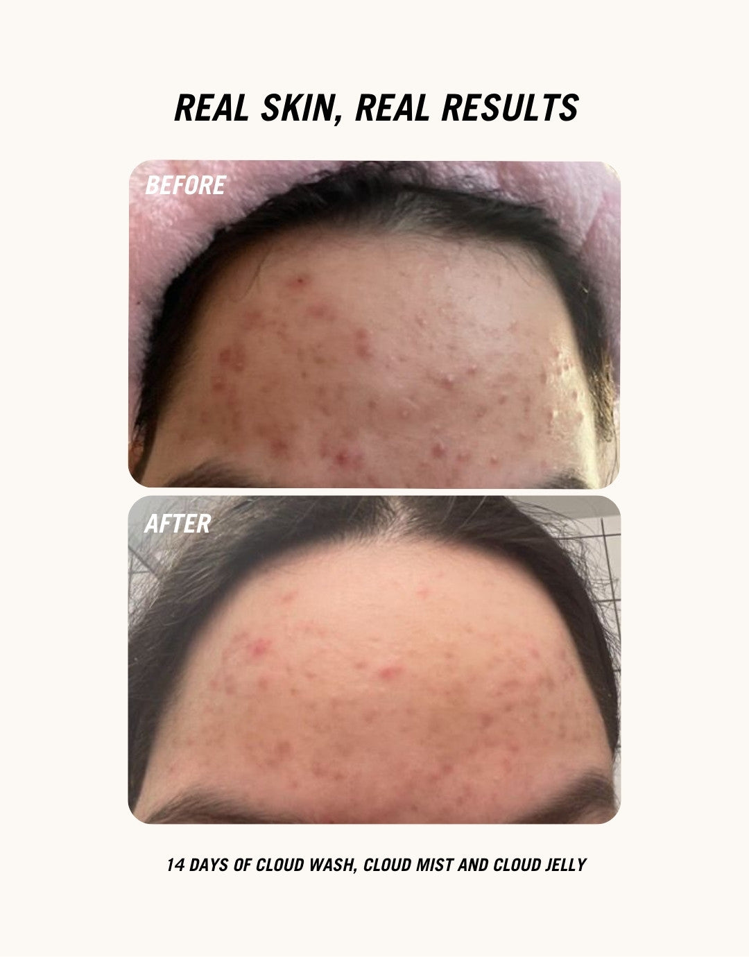 Before and after image of a girl showing her forehead after having used Common Clouds skincare products.