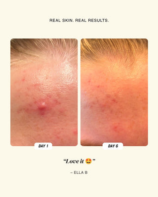 Before and after comparison of skin, labeled 