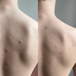 Before and after results on back blemishes using Common Clouds pimple patches