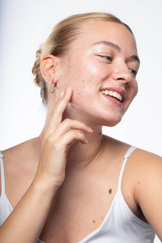 A happy girl with acne scars and glowing skin after using Cloud Mist