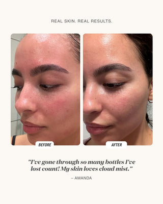 Before and after skincare comparison showing a woman
