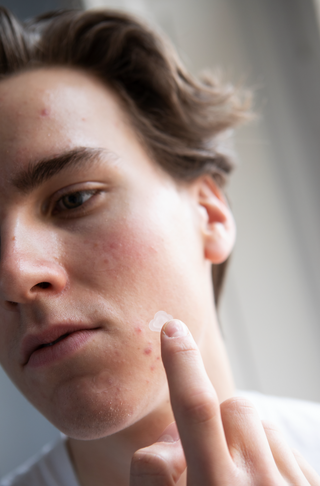 A person applying Cloud Patch to a pimple